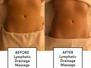 What is a Post Lymphatic Massage